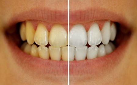 اصفرار الأسنان الأسباب والوقاية والعلاج