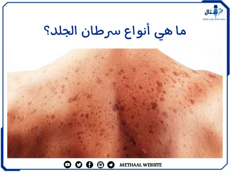 ما هي أنواع سرطان الجلد؟
