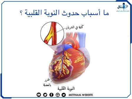 ما أسباب حدوث النوبة القلبية ؟