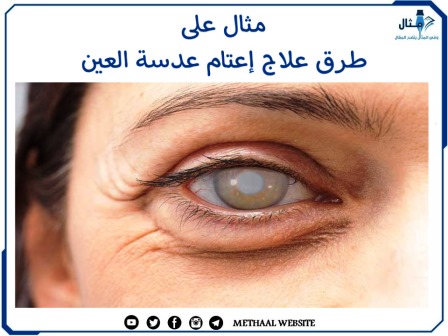 مثال على طرق علاج إعتام عدسة العين