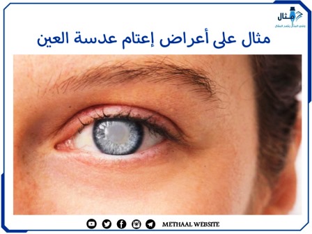 مثال على أعراض إعتام عدسة العين